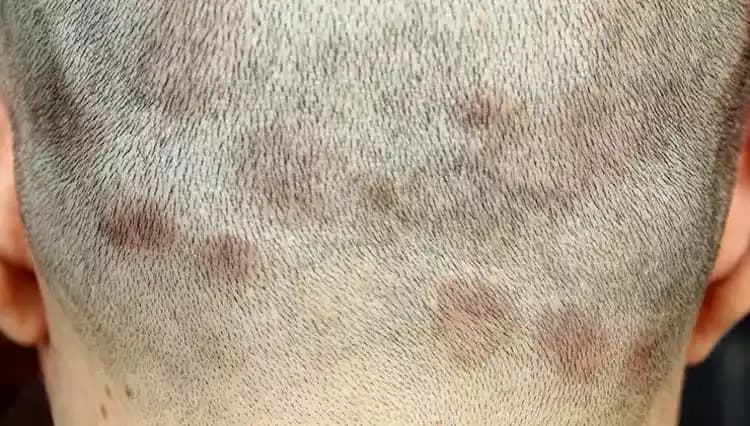 Saç Derisinde Mantar Nedenleri, Belirtileri ve Etkili Tedavi Yöntemleri