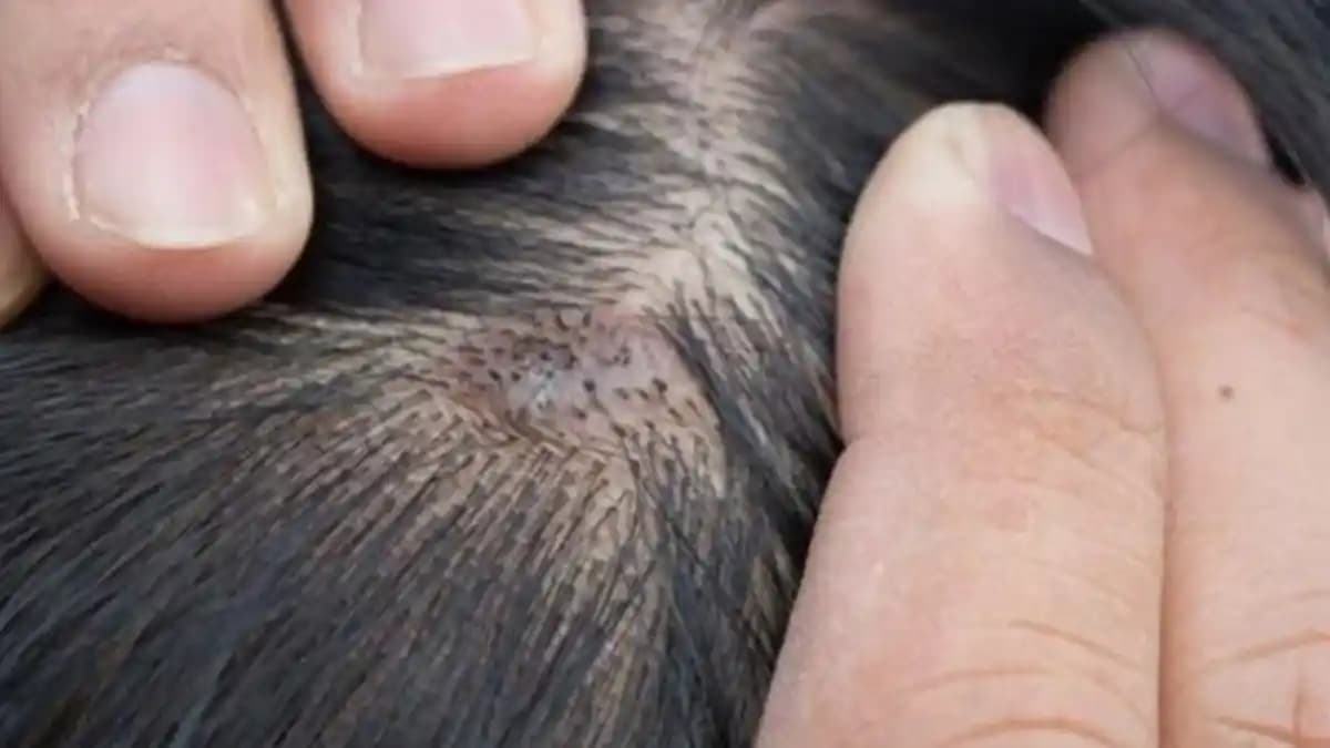 Saç Derisinde Yara ve Kabuklanma Nedenleri ve Etkili Tedavi Yöntemleri