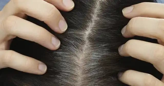 Saç Dipleri Ağrısı: Nedenleri, Belirtileri ve Etkili Çözüm Yöntemleri