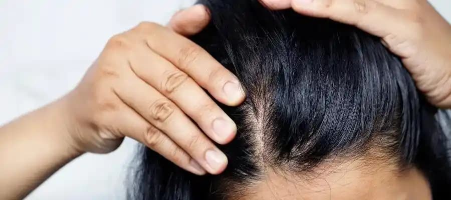 Saç Mantarı Neden Olur? Belirtileri, Tedavisi ve Korunma Yolları Hakkında Bilgi