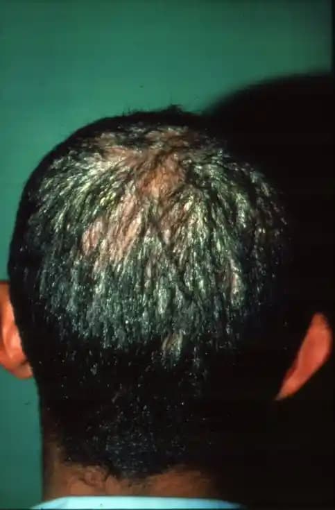 Saç Mantarı Nedir? Belirtileri, Nedenleri, Tedavisi ve Korunma Yöntemleri