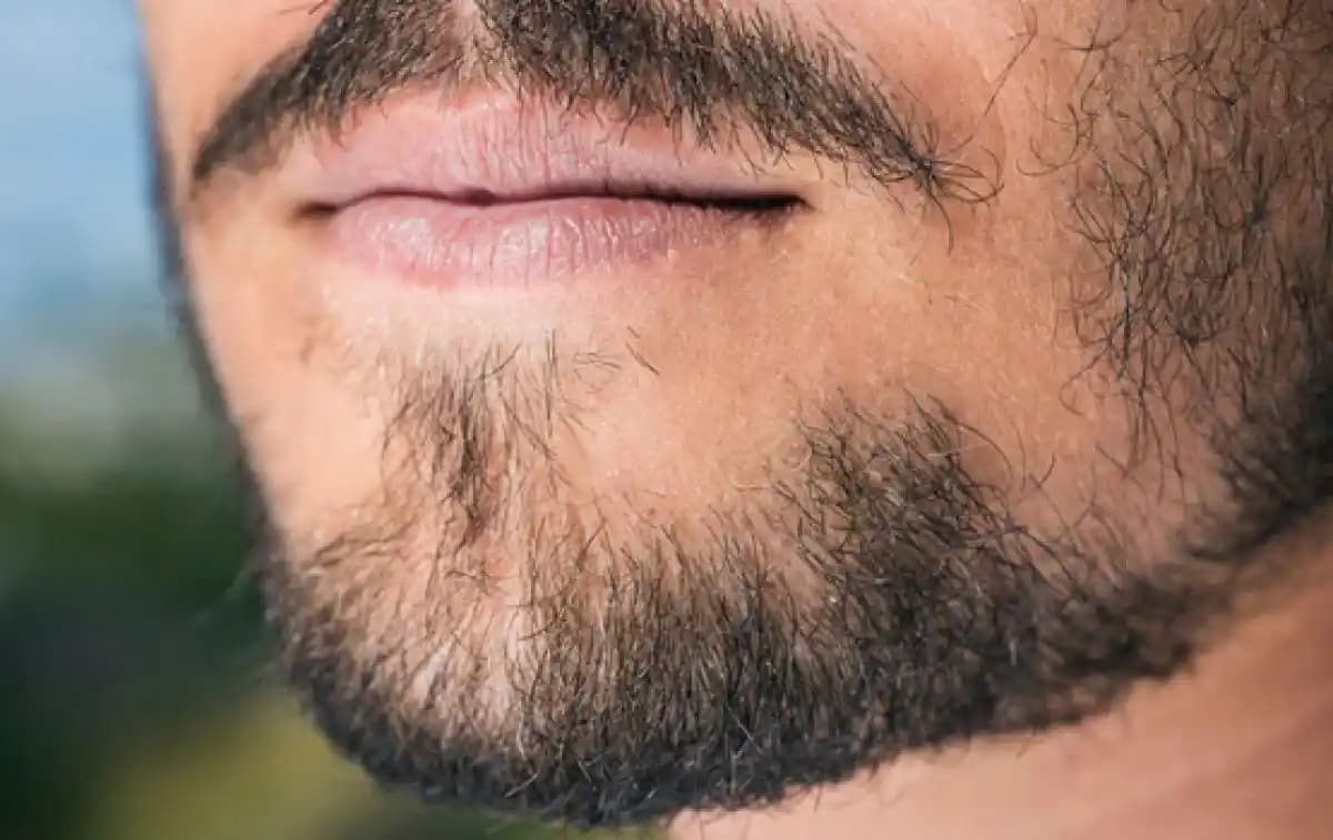 Sakal Kıran Nedir? Nedenleri, Türleri ve Etkili Tedavi Yöntemleri Hakkında Bilgi