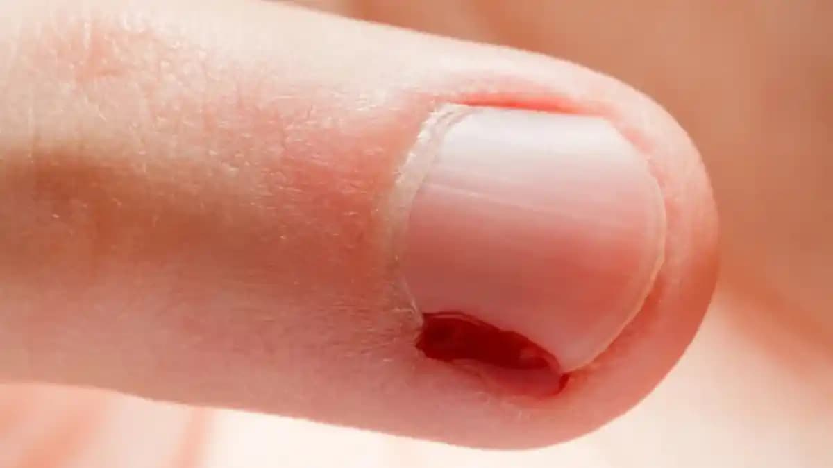 Şeytan Tırnağı Nedir? Nedenleri, Önleme Yolları ve Tedavi Seçenekleri