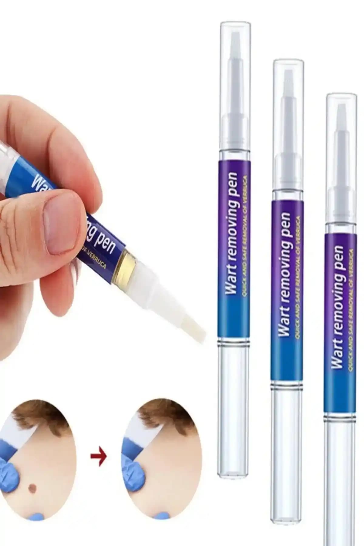 Siğil Kalemi ile Etkili ve Pratik Siğil Tedavisi: Kullanım, Avantajlar ve Dikkat Edilmesi Gerekenler