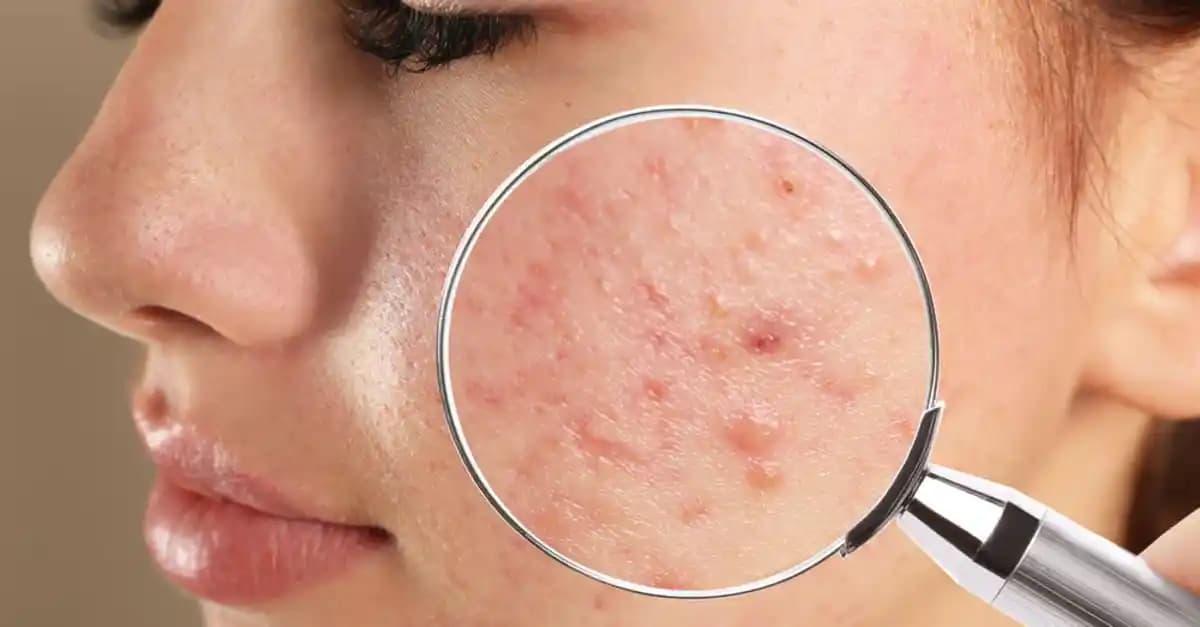 Şişen Sivilce Nedenleri, Tedavi Yöntemleri ve Önleme İpuçları Hakkında Bilgi