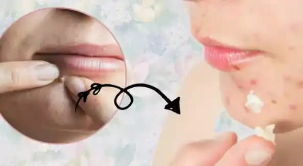 Sivilce İzlerini Geçiren Kremler ve Etkili Cilt Bakım Yöntemleri Hakkında Bilgiler