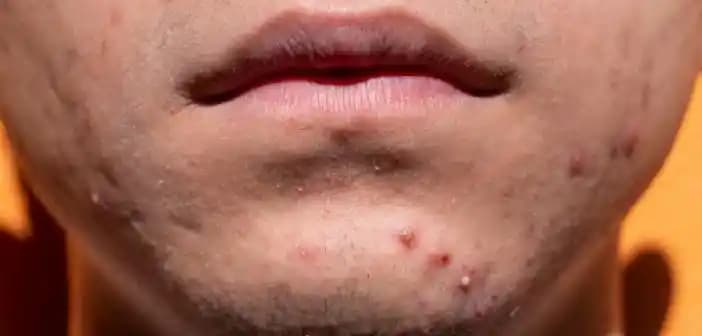 Sivilce Yaraları: Nedenleri, Türleri ve Etkili Tedavi Yöntemleri Hakkında Bilgi