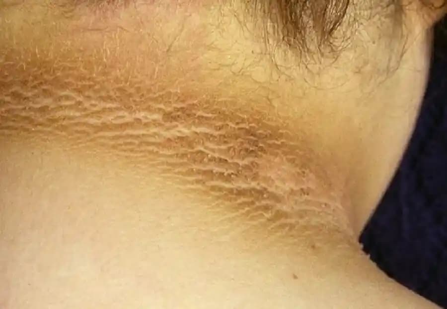 Siyah Lekeler: Nedenleri, Önlenmesi ve Etkili Tedavi Yöntemleri Hakkında Bilgi