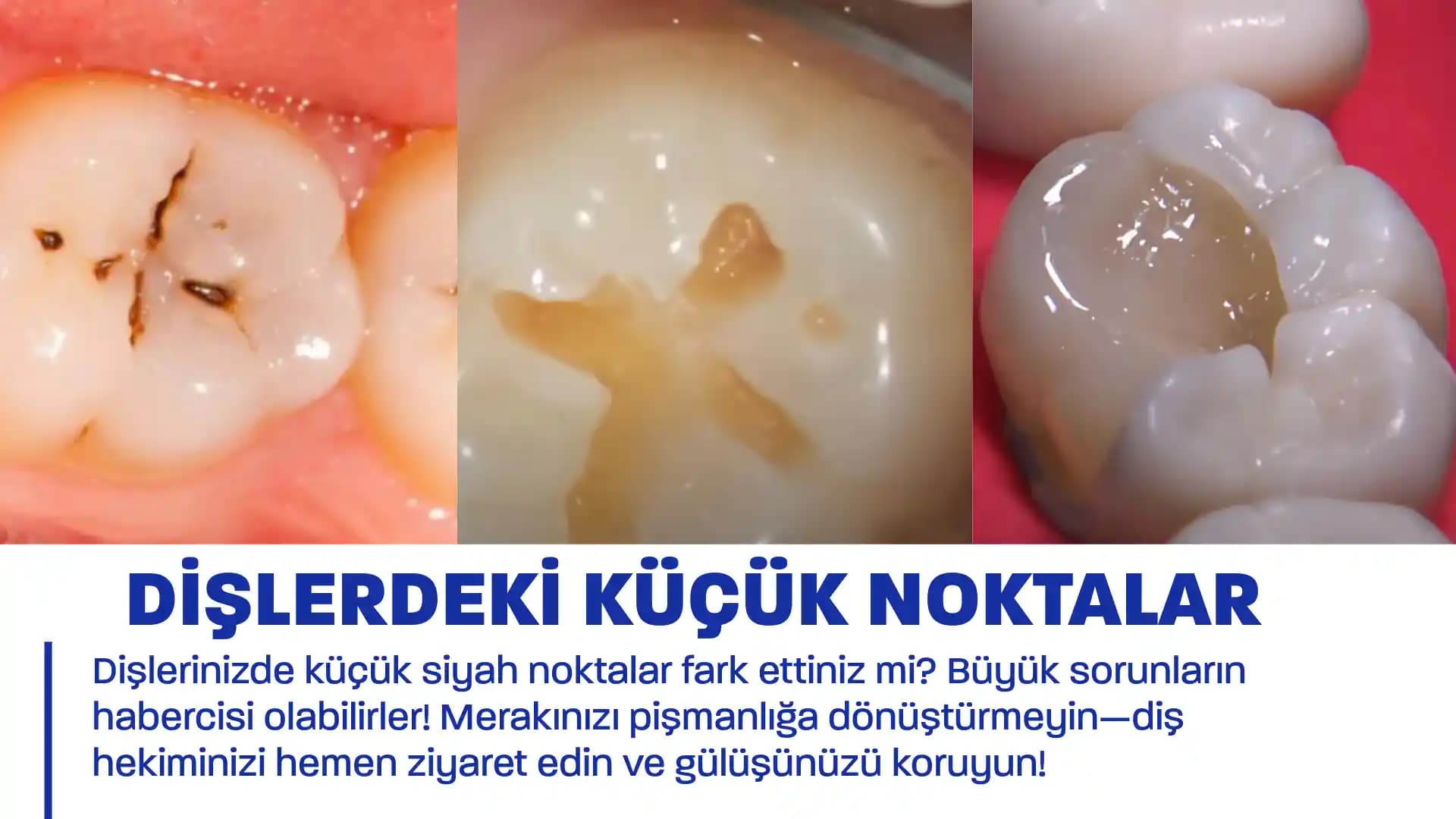 Siyah Lekeler: Nedenleri, Türleri ve Etkili Önleme ile Tedavi Yöntemleri