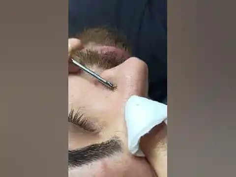 Siyah Nokta Çıkarma ve Cilt Bakımında Etkili Yöntemler: Doğal ve Profesyonel Çözümler