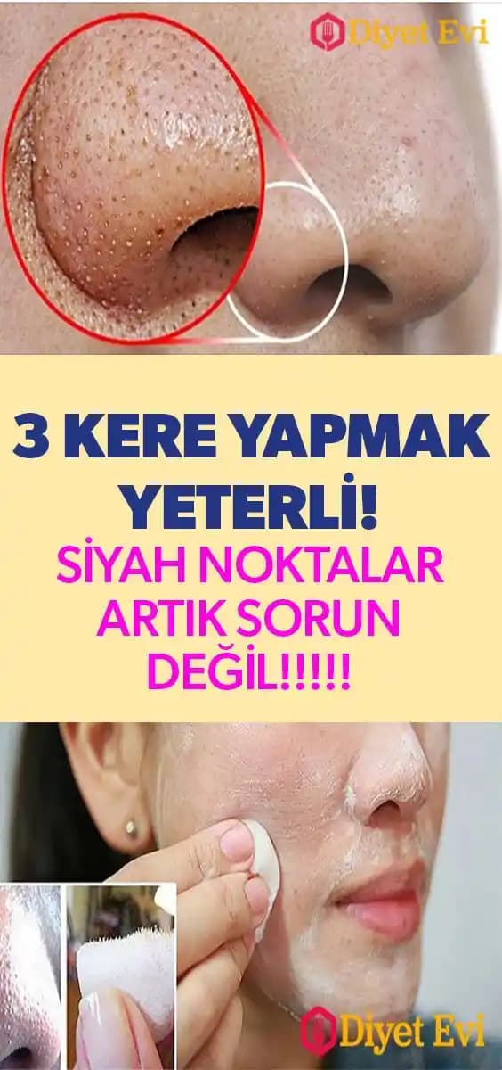 Siyah Noktalar İçin Etkili Cilt Bakımı ve Doğal Yöntemlerle Sağlıklı Cilt Rehberi