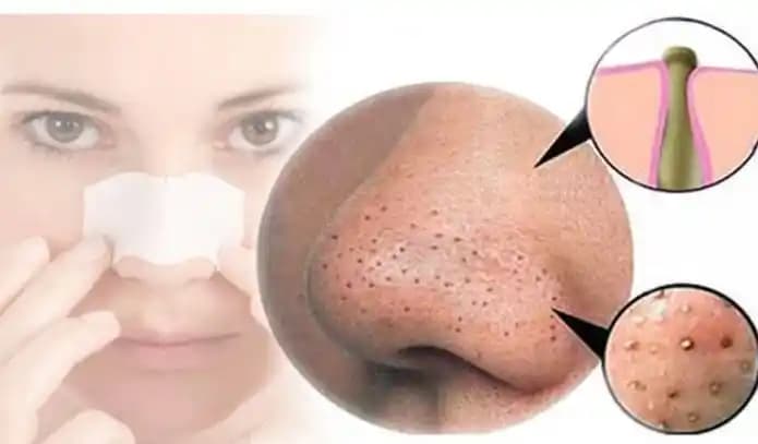 Siyah Noktalardan Kurtulma Yöntemleri: Doğal, Kozmetik ve Profesyonel Çözümler