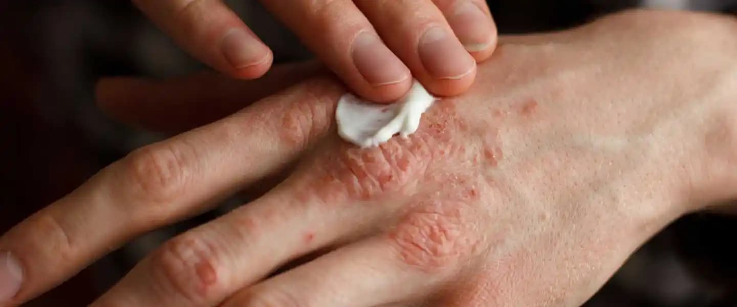 Sulu Egzama Belirtileri ve Tedavi Yöntemleri: Cilt Sağlığınızı Korumak İçin Rehber