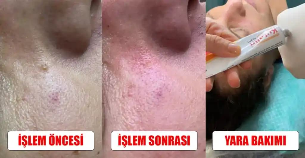Sulu Yara Neden Olur? Enfeksiyonlar, Alerjiler ve Cilt Bakımı Hakkında Bilgiler