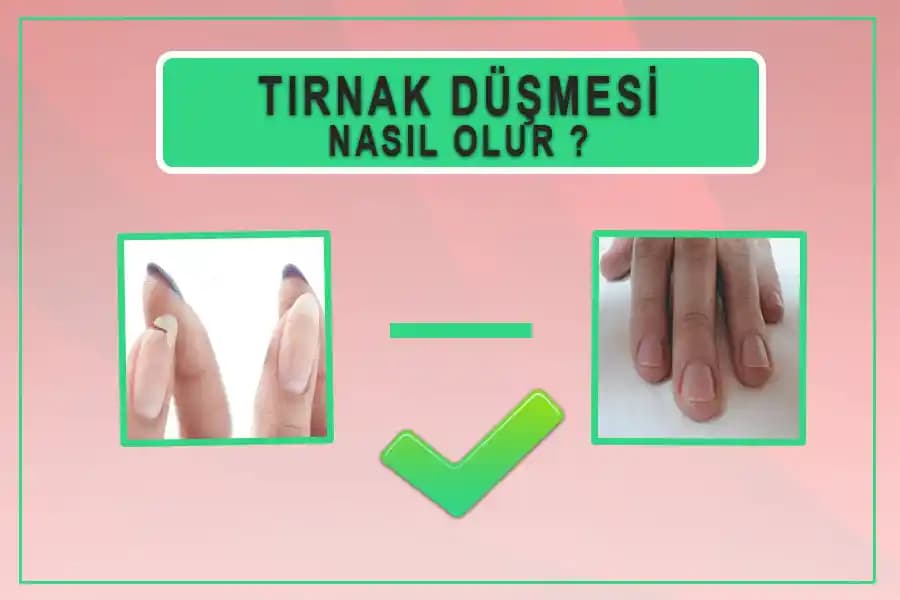 Tırnak Düşmesi: Nedenleri, Önlenmesi ve Etkili Tedavi Yöntemleri Rehberi