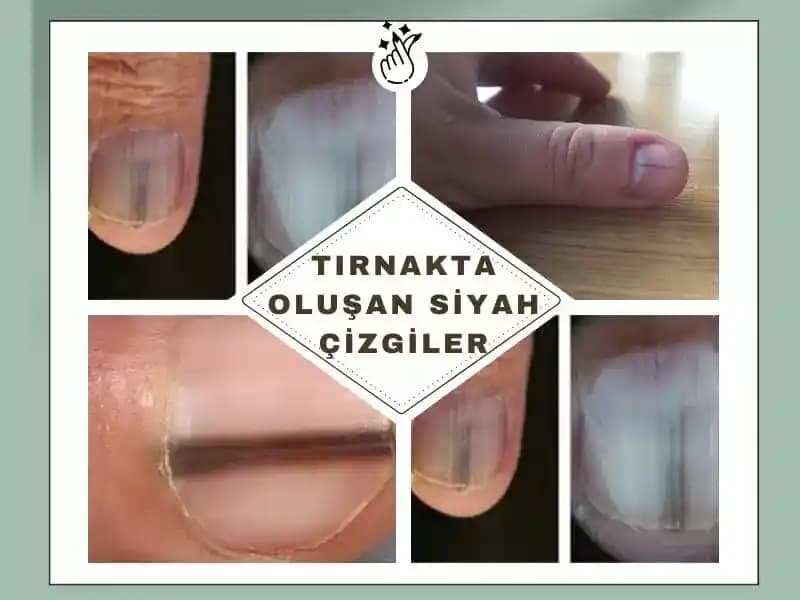 Tırnakta Siyah Çizgiler: Nedenleri, Tanısı ve Etkili Bakım Yöntemleri