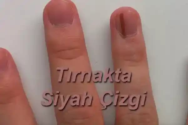 Tırnakta Siyah Nokta Nedenleri, Tedavisi ve Etkili Güzellik İpuçları