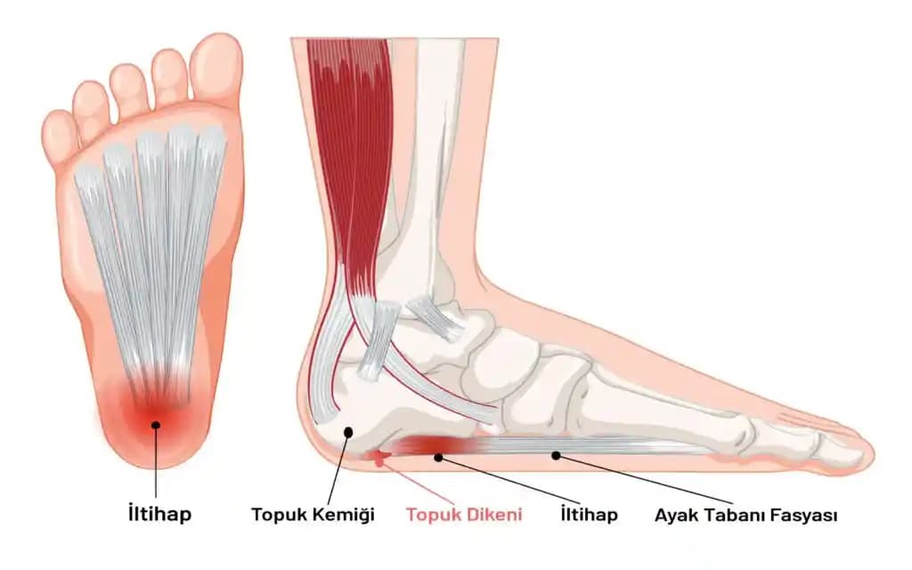Topuk Sertleşmesi Nedenleri, Belirtileri ve Etkili Bakım Yöntemleri Hakkında Bilgi