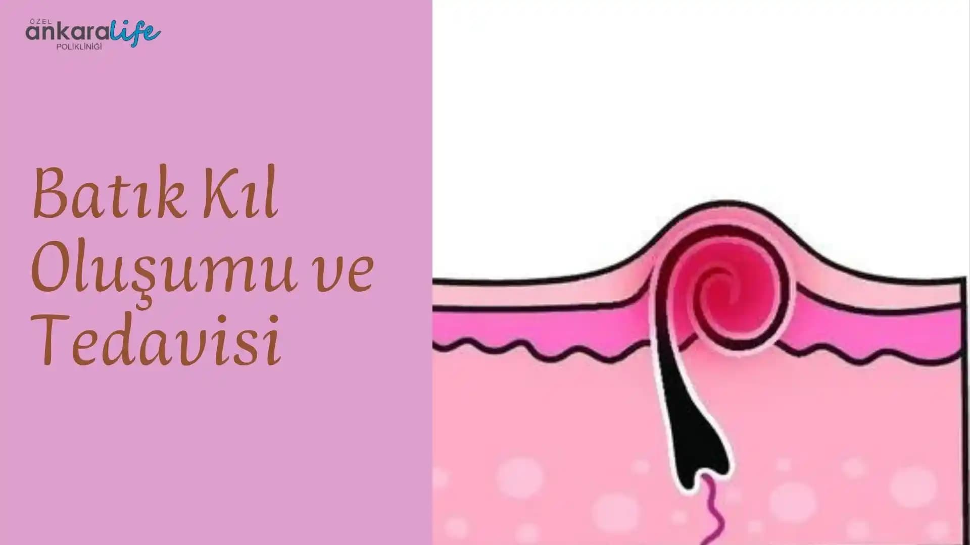 Vajinada Batık Kıl: Nedenleri, Belirtileri ve Etkili Tedavi Yöntemleri