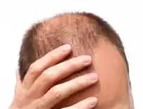 Vaks Saç Dökümü Yapar mı? Saç Bakımında Vaksın Etkileri ve Kullanım Önerileri