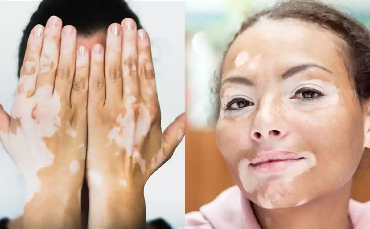 Vücutta Beyaz Lekeler: Nedenleri, Tedavi Yöntemleri ve Önleme Önerileri