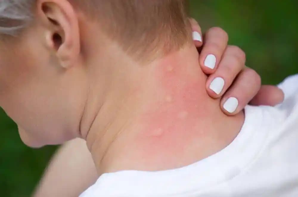 Vücutta Kabarma Nedenleri, Belirtileri ve Etkili Bakım Yöntemleri Hakkında Bilgi