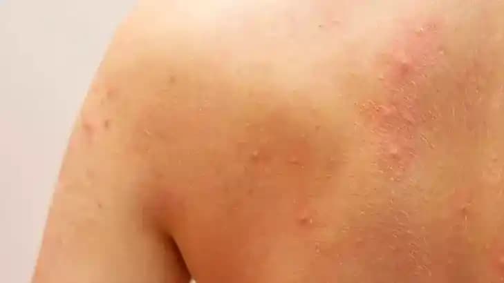 Vücutta Kabarma ve Kaşıntı: Nedenleri, Belirtileri ve Etkili Tedavi Yöntemleri