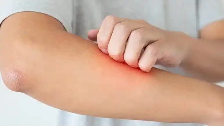 Vücutta Kaşıntılı Kabarcıklar: Nedenleri, Tedavi Yöntemleri ve Koruyucu Öneriler