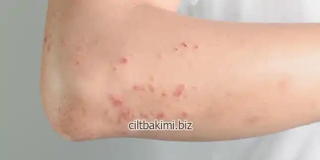 Vücutta Kaşıntısız Kırmızı Lekeler: Nedenleri, Tanısı ve Etkili Bakım Önerileri