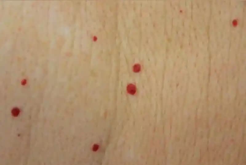 Vücutta Kırmızı Noktalar: Nedenleri, Belirtileri ve Etkili Tedavi Yöntemleri