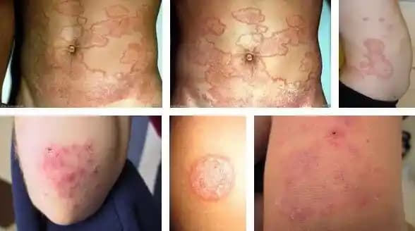 Vücutta Mantar Lekeleri: Nedenleri, Belirtileri ve Etkili Tedavi Yöntemleri