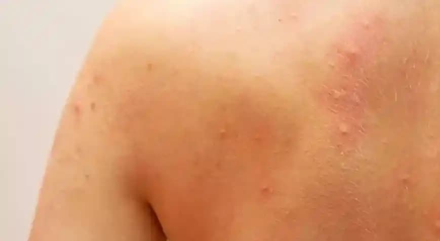 Vücutta Minik Kabarcıklar: Nedenleri, Türleri ve Etkili Bakım Yöntemleri