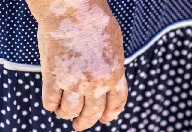 Vücutta Oluşan Beyaz Lekeler: Nedenleri, Tedavi Yöntemleri ve Cilt Bakımı Önerileri