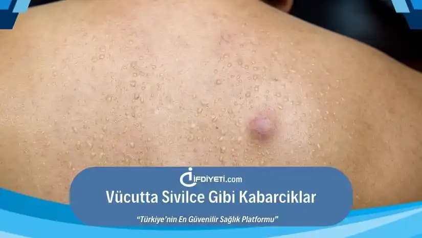 Vücutta Sivilce Gibi Kabarcıklar: Nedenleri, Tedavisi ve Korunma Yöntemleri
