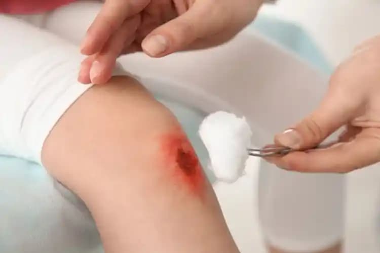 Yaralarda Vazelin Kullanımı: Doğru Yöntemler ve Dikkat Edilmesi Gerekenler