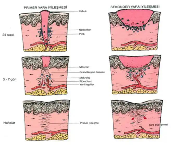 Yaraların Geç İyileşme Nedenleri ve Güzellik Perspektifinden Kişisel Bakım Önerileri