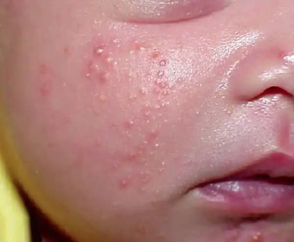 Yeni Doğan Bebek Yüzünde Sivilce: Nedenleri, Belirtileri ve Etkili Bakım Yöntemleri