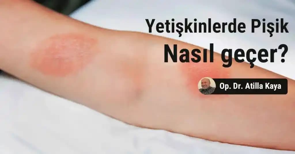 Yetişkinlerde Pişik Nedenleri, Önleme Yöntemleri ve Etkili Tedavi Yaklaşımları
