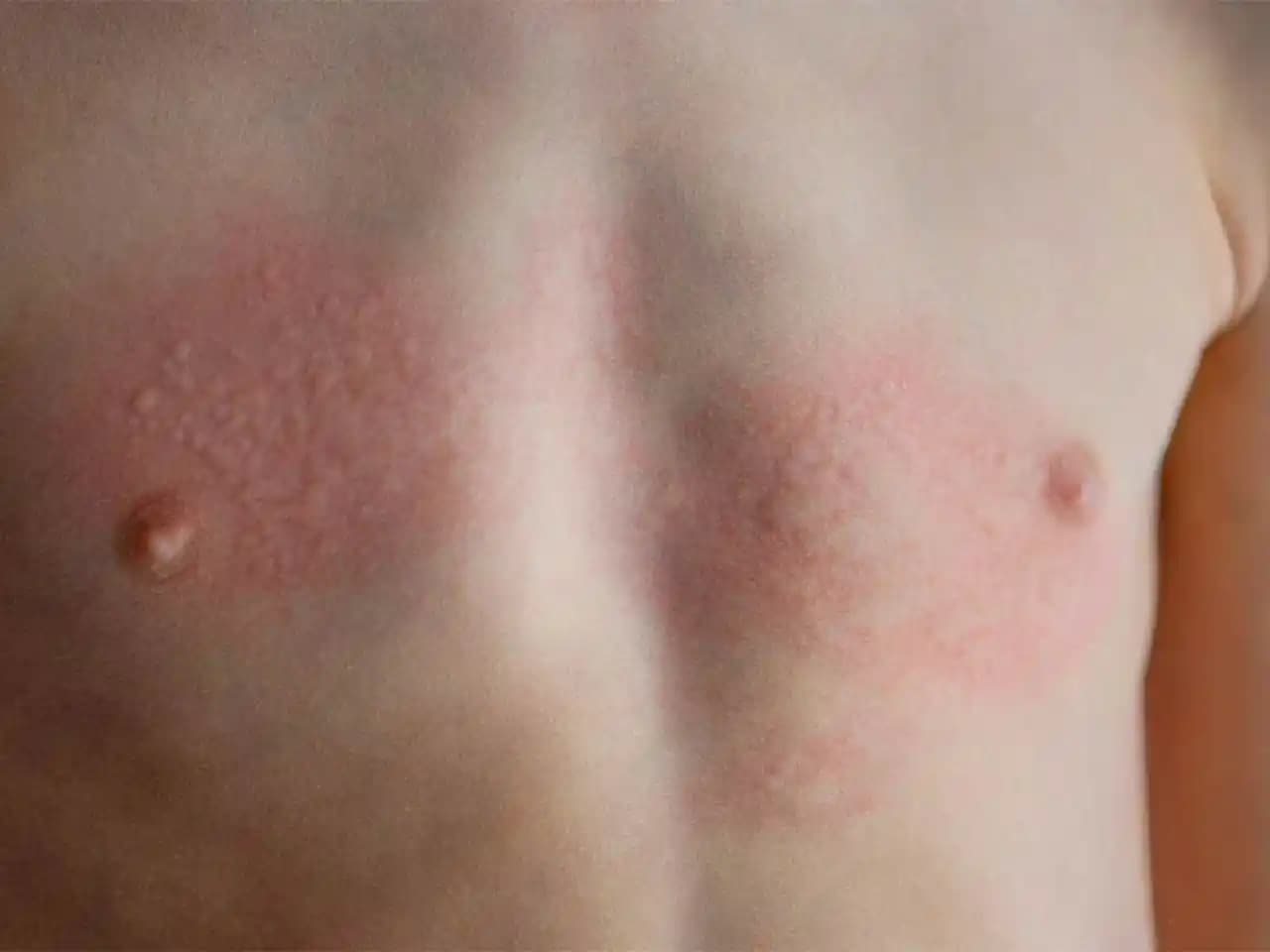 Yetişkinlerde Pişik Nedir? Belirtileri, Önleme ve Etkili Tedavi Yöntemleri