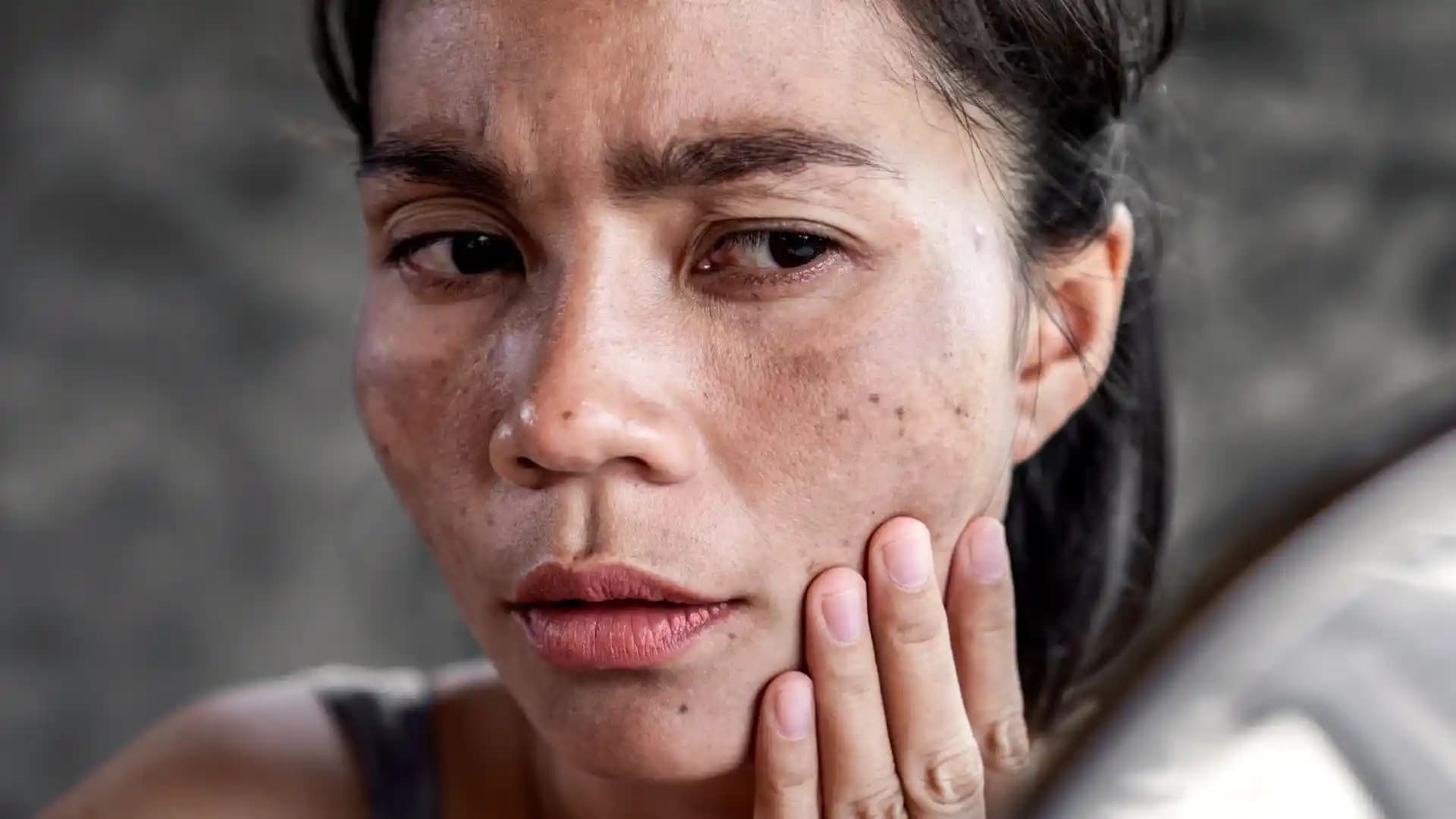 Yüz Kararması Nedenleri ve Önleme Yöntemleri: Cilt Sağlığınızı Korumak İçin Bilmeniz Gerekenler