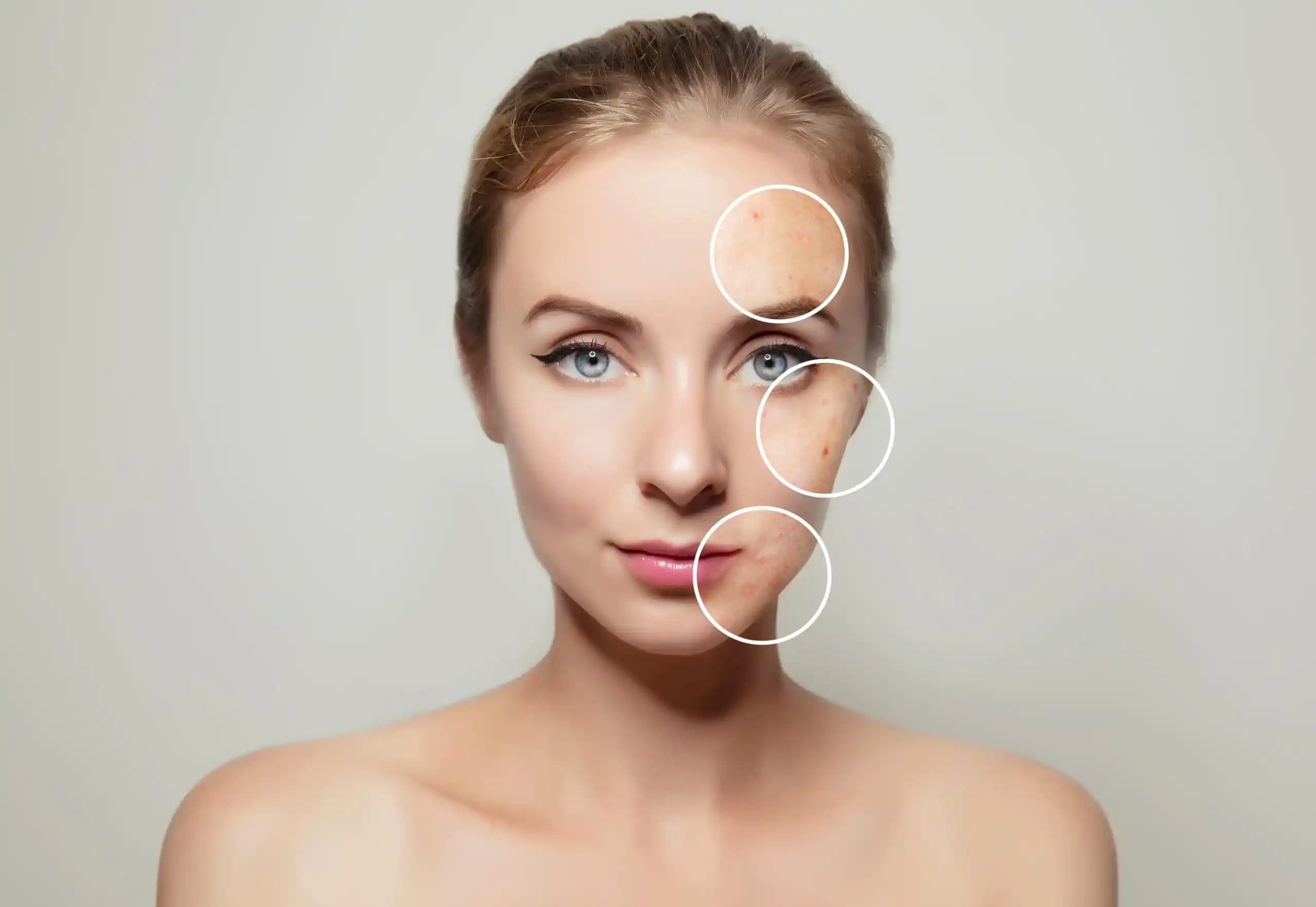 Yüz Lekeleri Türleri, Nedenleri ve Etkili Tedavi Yöntemleri Hakkında Bilgi