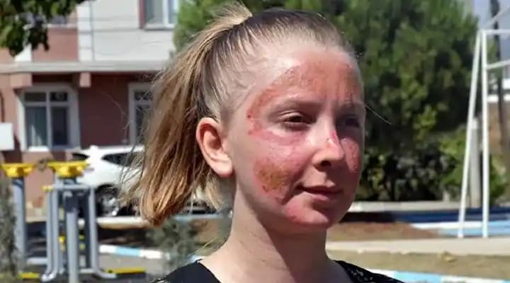 Yüz Yanığı Nedenleri, Tedavisi ve Sonrası Cilt Bakımı Hakkında Önemli Bilgiler