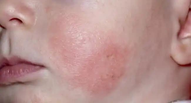 Yüzde Egzama Belirtileri ve Etkili Tedavi Yöntemleri ile Cilt Bakımı Rehberi