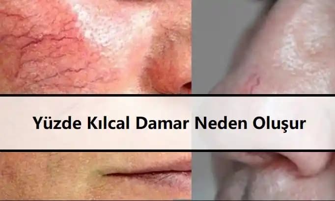 Yüzde Kılcal Damar Neden Çıkar? Sebepler, Korunma ve Tedavi Yöntemleri