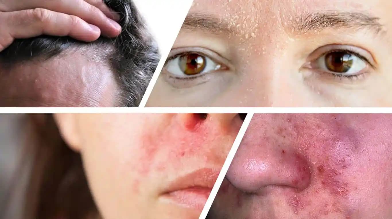 Yüzde Seboreik Dermatit: Belirtiler, Bakım Önerileri ve Etkili Tedavi Yöntemleri