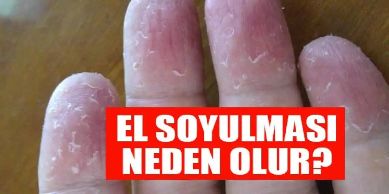 Yüzde Soyulma Nedenleri ve Korunma Yöntemleri: Cilt Sağlığınızı Nasıl Korumalısınız