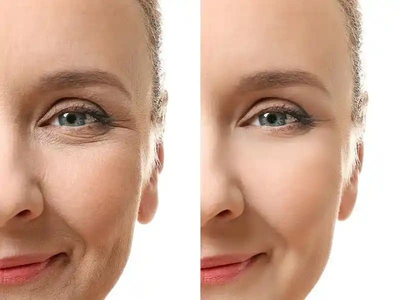 Yüzdeki Çizgilerin Azaltılması İçin Etkili Yöntemler ve Cilt Bakım Önerileri