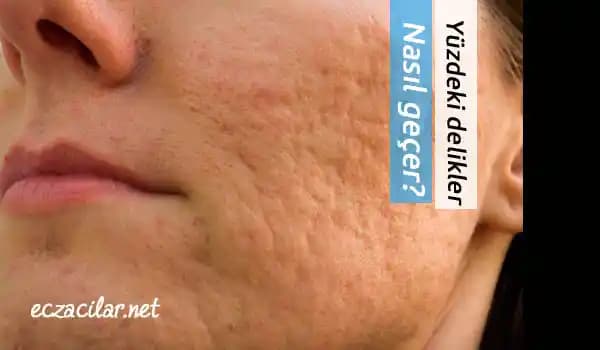 Yüzdeki Delikler ve Gözenekler: Nedenleri, Bakımı ve Profesyonel Tedavi Yöntemleri