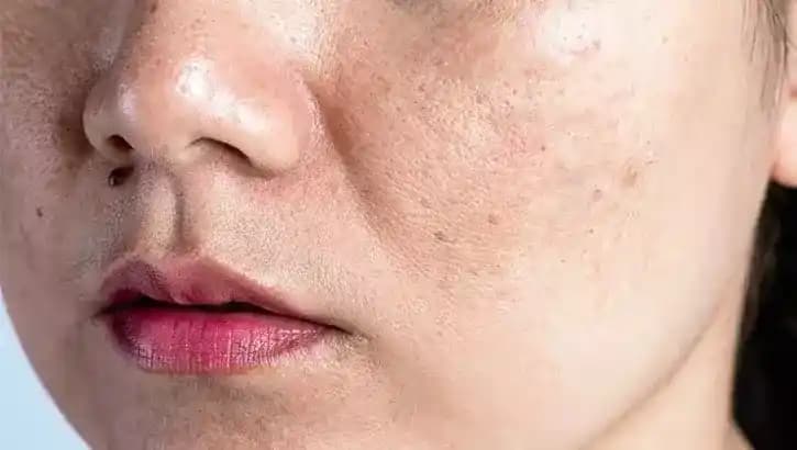 Yüzdeki Deliklere Ne İyi Gelir? Gözenek Bakımı ve Etkili Yöntemler