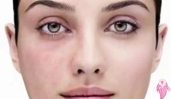 Yüzdeki Kırmızı Noktaların Nedenleri, Tedavi Yöntemleri ve Korunma Önerileri